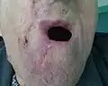 Followup 12 days after 1st surgery