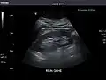 Left kidney