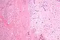 Atrial myxoma and myocardium. H&E stain.