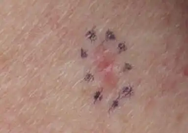 BCC on the left upper back, nodular and micronodular, marked for biopsy