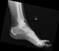 Ectopic calcification and new bone formation in diffuse idiopathic skeletal hyperostosis (DISH)