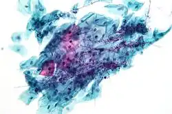 Candida organisms on a pap test.