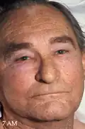 A man with a swollen face