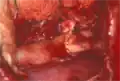 Coarctatio aortae - after end-to-end anastomosis.