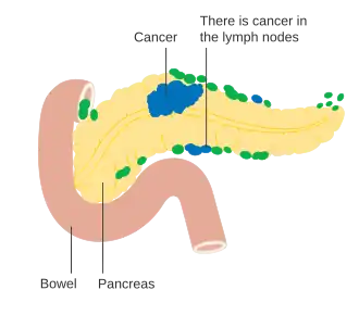 Involvement of nearby lymph nodes – Stage N1