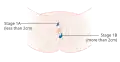 Stage 1A and 1B vulvar cancer