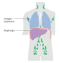 Stage 1 Hodgkin lymphoma