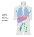 Stage 3 Hodgkin lymphoma