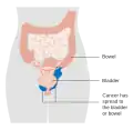 Stage 4A vaginal cancer
