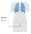 Stage 4B vaginal cancer