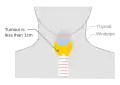 Stage T1a thyroid cancer