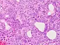 Grade 2: >5% and ≤50% solid non-glandular, non-squamous growth.[62]