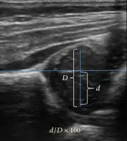 Measurement of femoral head coverage.[1]