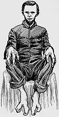 Tetradactyly
