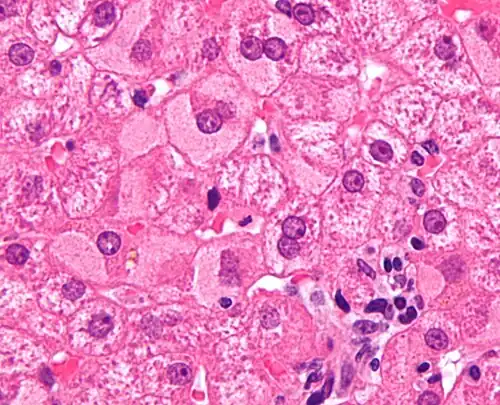 Ground glass hepatocytes