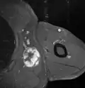 Fig. 7 MRI of myxoid liposarcoma of high grade, in the left axillary region of 40-year-old man, highlighted by its white color, in this horizontal section of the tumor.