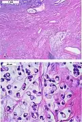 Signet ring cell carcinoma of the ileum. H&E stain