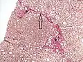 Histopathology of steatohepatitis with moderate fibrosis, with thin fibrous bridges (Van Gieson's stain)[97]