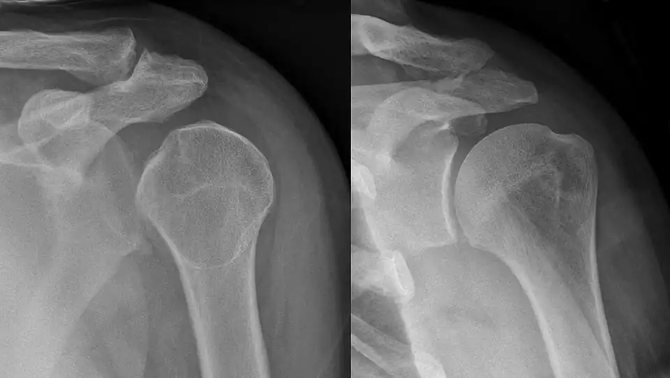 Shoulder dislocation before (left) and after (right) being reduced
