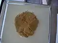 Lipoma removed from the breast