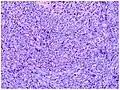 Micrograph of tumor stage. Well-circumscribed spindle-cell tumor. Erythrocytes lie within poorly defined slit-like vascular spaces.[16]