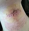 Post removal of stitches from surgery on a Thyroglossal Cyst infection
