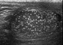 Fig. 25. Testicular microlithiasis. Multiple hyperechoic foci without acoustic shadow presenting as a starry sky appearance is seen in the testis.[citation needed]