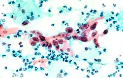Squamous cell carcinoma in the cervix.