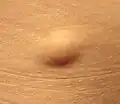Lipoma[6]