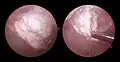 A tophus being removed from inside a knee joint by arthroscopic surgery
