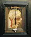 Trephining of the Skull, 1895. 36 x 30.5 x 9&nbsp;cm. MuseumZeitraum Leipzig.