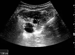Figure 17. Same patient as in Figure 16 with measurement of the pelvis dilation in the transverse scan plane illustrated on the US image with '+' and a dashed line.[1]