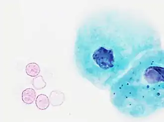 Red blood cells, indicating hematuria.