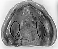 Upper denture
