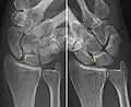 Dynamic instability: Increased scapholunate distance (between yellow lines) upon ulnar deviation of the wrist, but not otherwise.